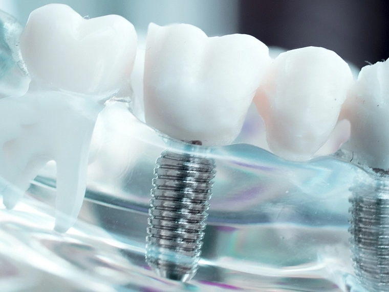 implantes-clinica-guillen